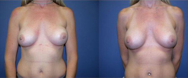 Breast Implant Revision before and after image.