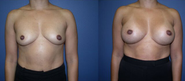breast-aug-before-after-1 Breast augmentation before and after image.
