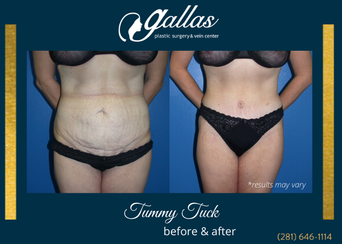 Before and after image showing the results of a tummy tuck performed in Katy, TX.