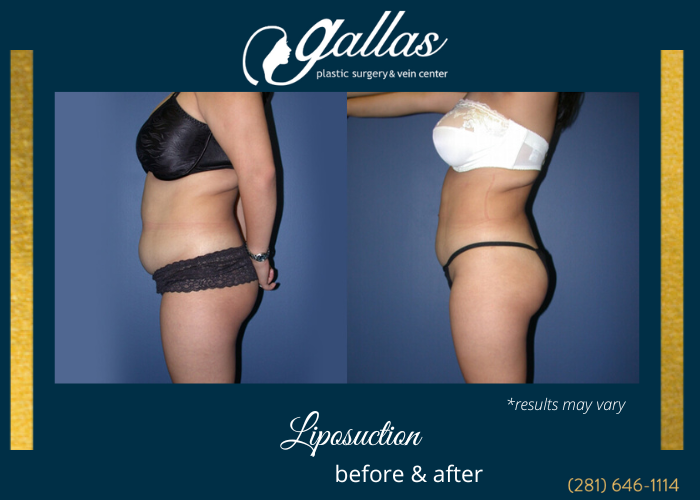 Before and after image showing the results of a liposuction procedure performed in Katy, TX.