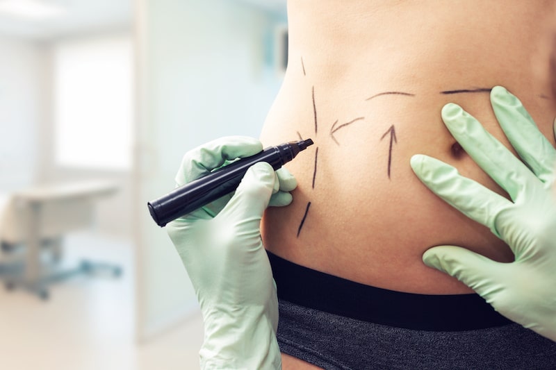 Close-up of a plastic surgeon making surgical marks with a pen on an woman's midsection in preparation for liposuction surgery