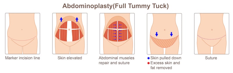 Illustration of how a fully tummy tuck is performed.