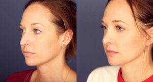 Before and After Image