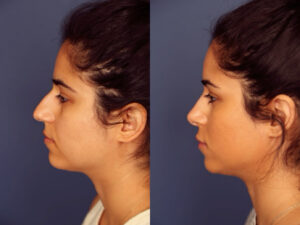 Before and After Image