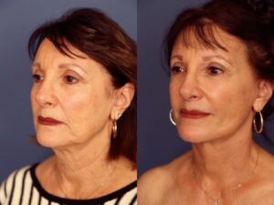 Before and After Image