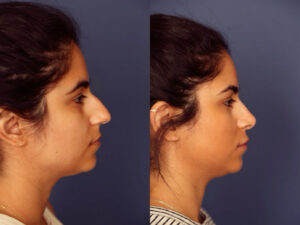 Before and After Image