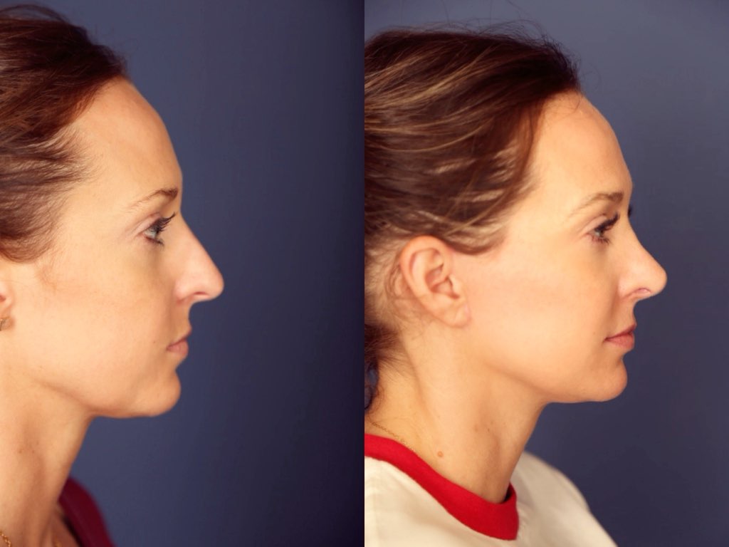 Before and After Image