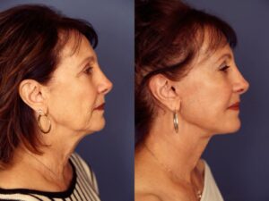 Before and After Image