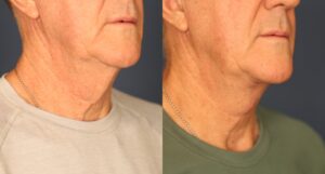 Before and After Image