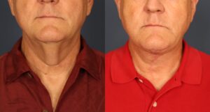 Before and After Image