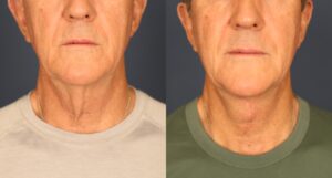 Before and After Image