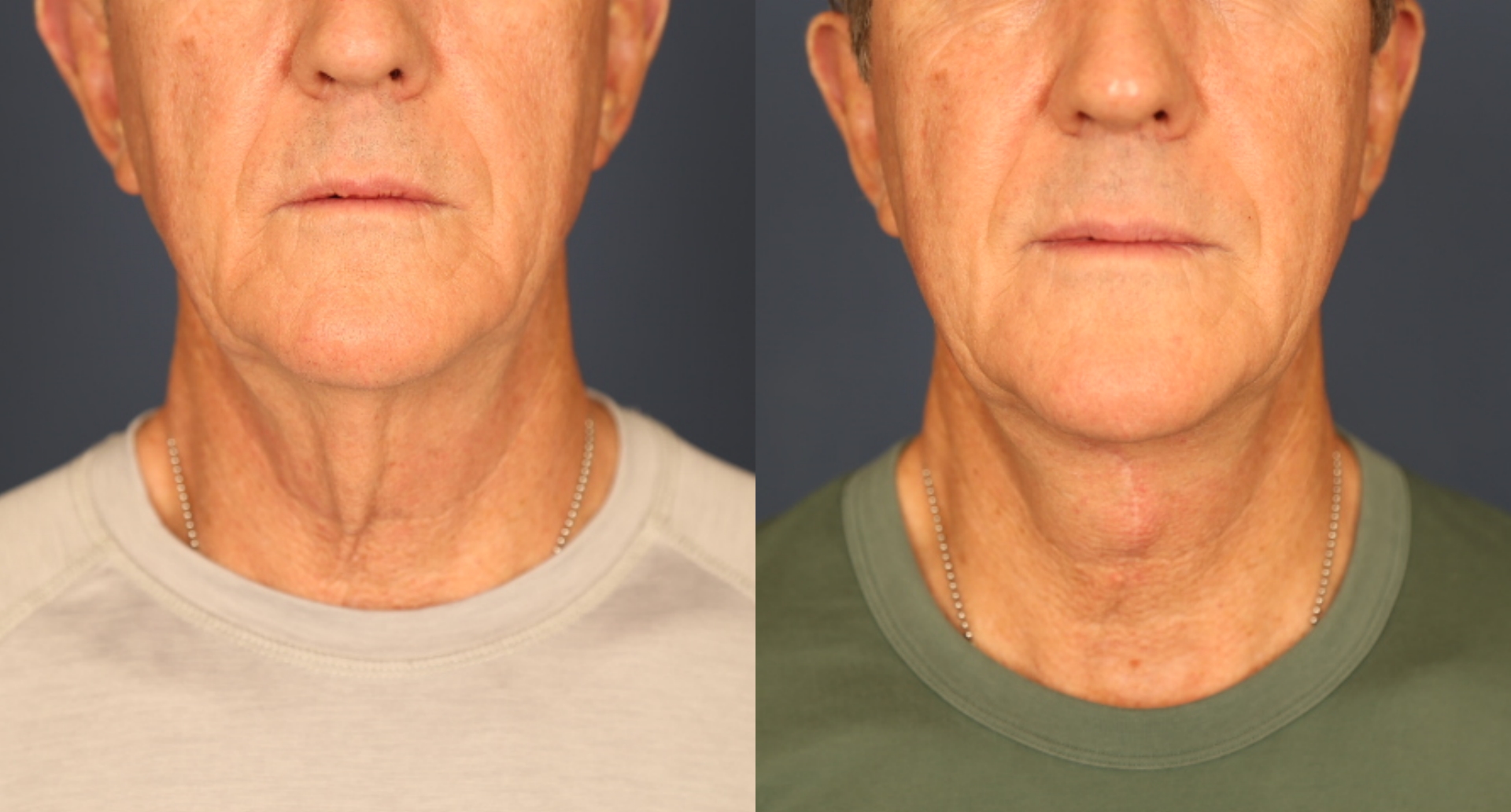 Before and After Image