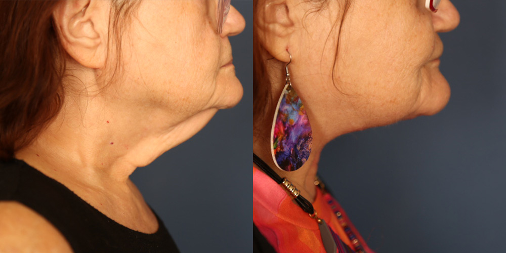 Before and After Image