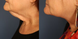 Before and After Image