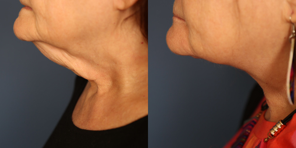 Before and After Image