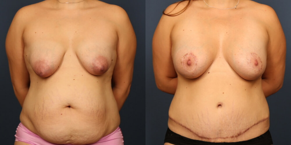 Before and After Image