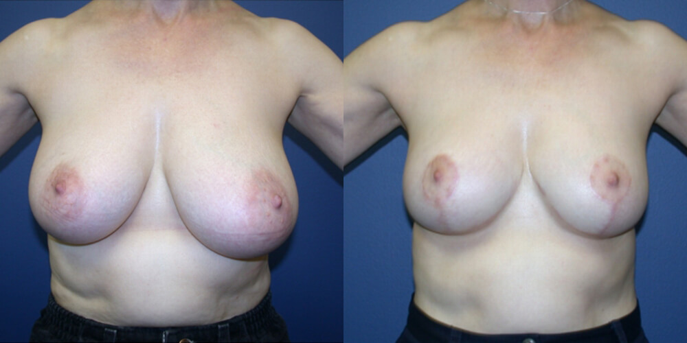 Before and After Image