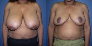 Before and After Image