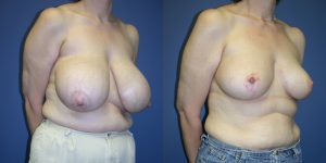 Before and After Image