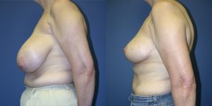 Before and After Image