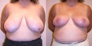 Before and After Image