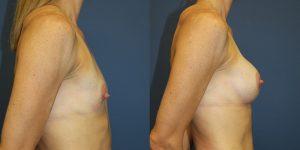 Before and After Image