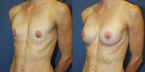 Before and After Image