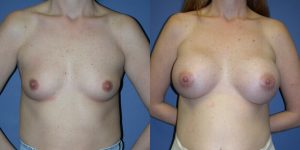 Before and After Image