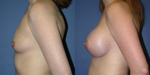 Before and After Image