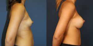 Before and After Image