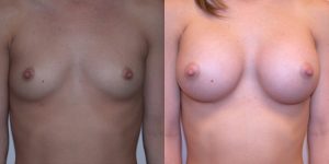 Before and After Image