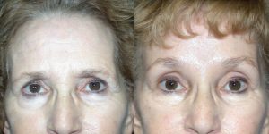 Before and After Image