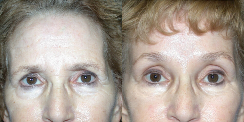 Before and After Image