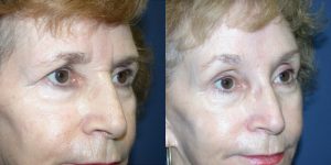 Before and After Image