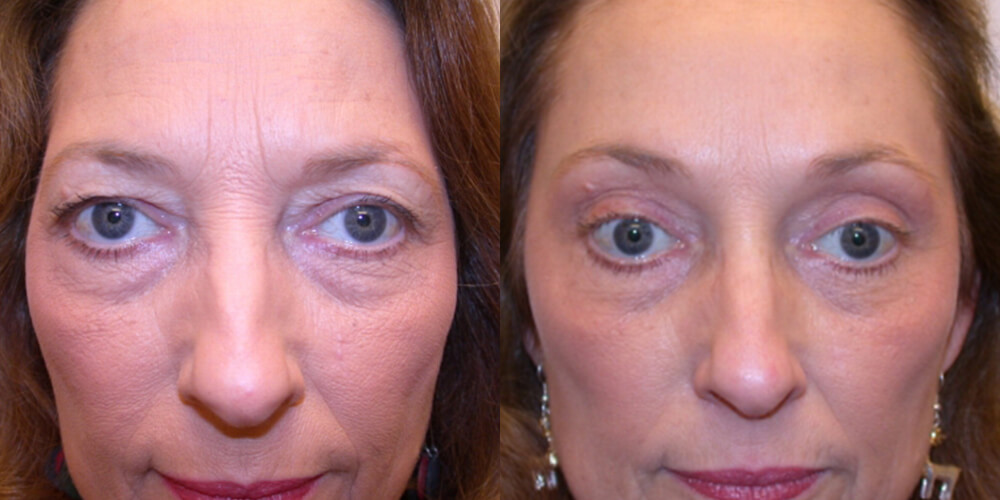 Before and After Image