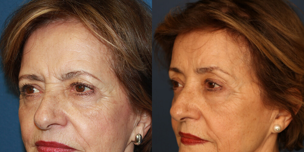 Before and After Image