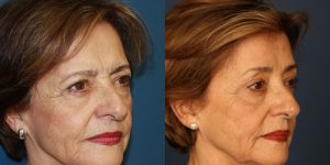 Before and After Image