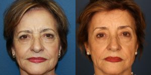 Before and After Image