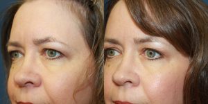 Before and After Image