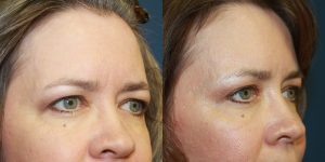 Before and After Image