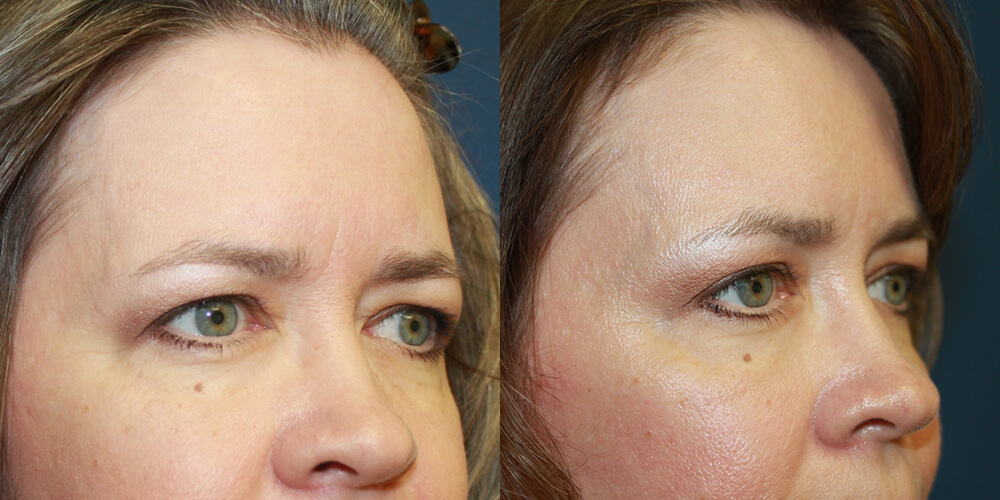 Before and After Image