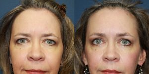 Before and After Image