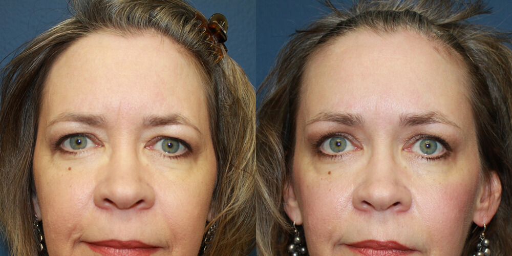 Before and After Image