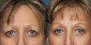 Before and After Image