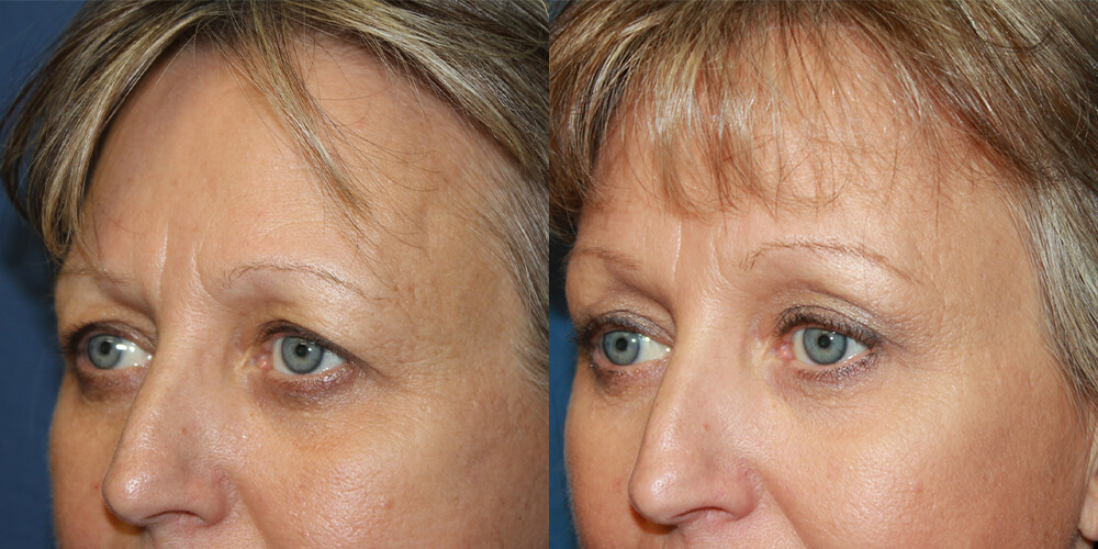 Before and After Image