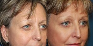 Before and After Image