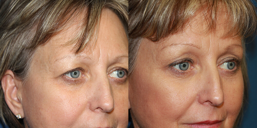 Before and After Image