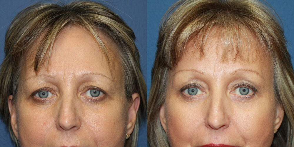 Before and After Image