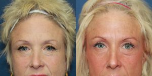 Before and After Image