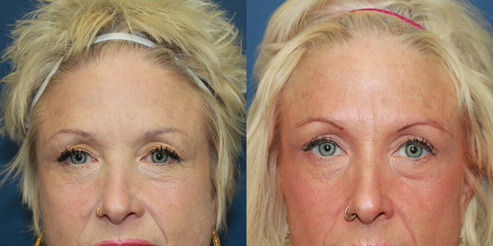 Before and After Image